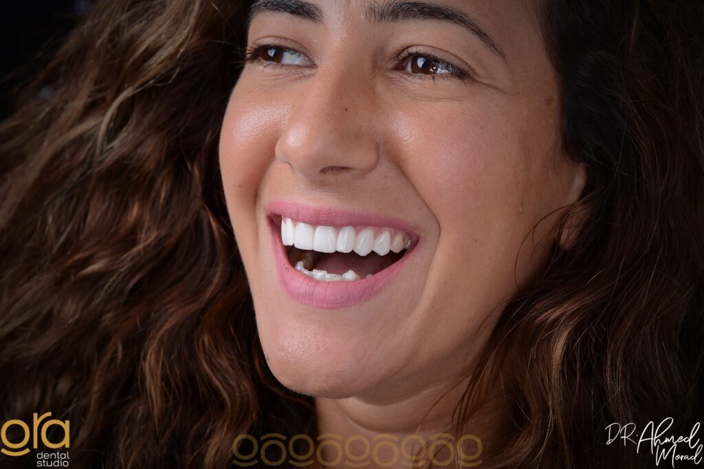 حشو العصب image