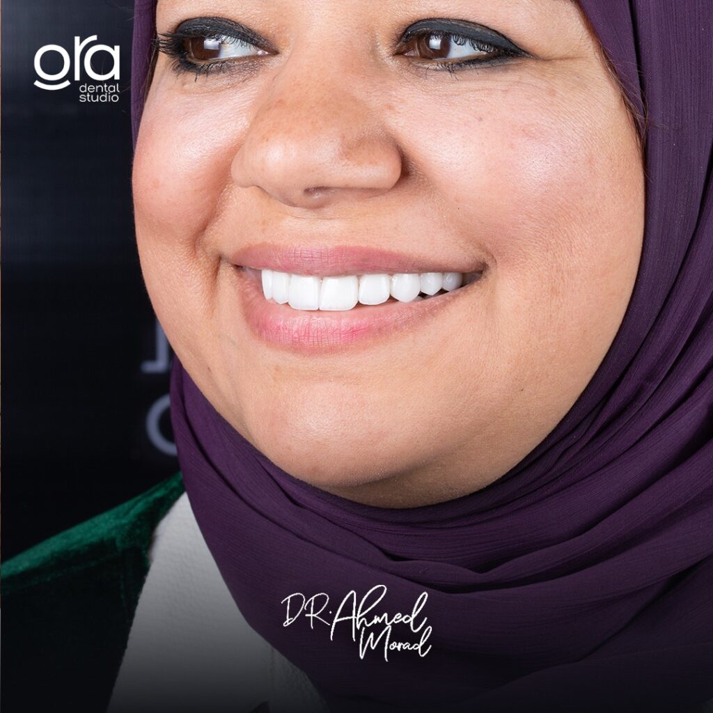 فينير الأسنان image