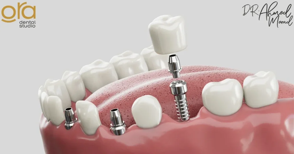 أفضل دكتور زراعة أسنان في القاهرة image