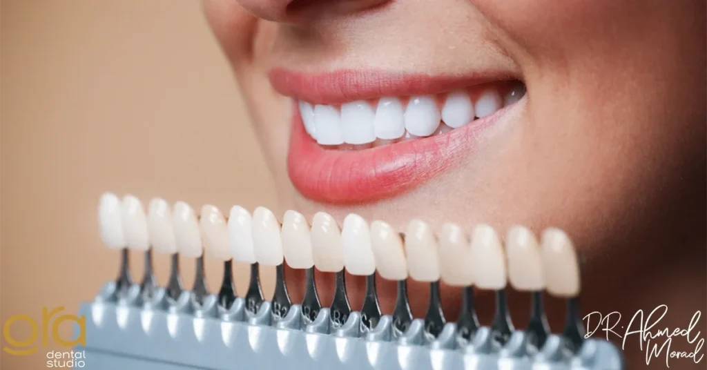 ما هو فينير الأسنان​ image