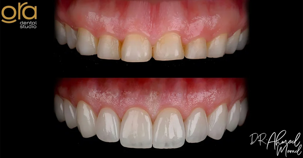 فينير الأسنان قبل وبعد​ image