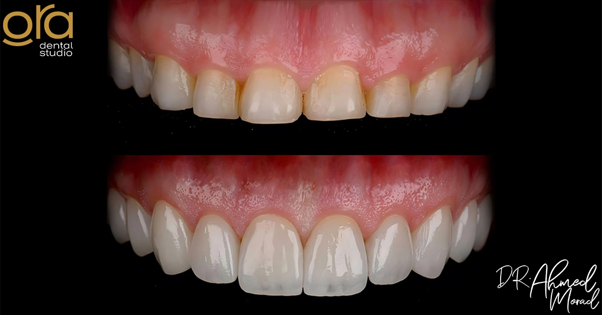 فينير الأسنان قبل وبعد