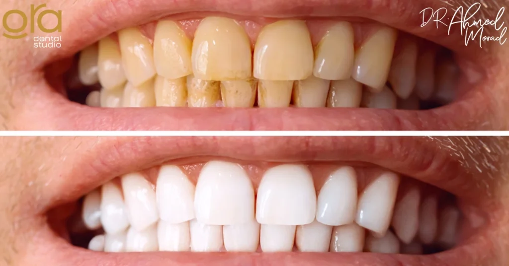 تبييض الأسنان بالليزر قبل وبعد image