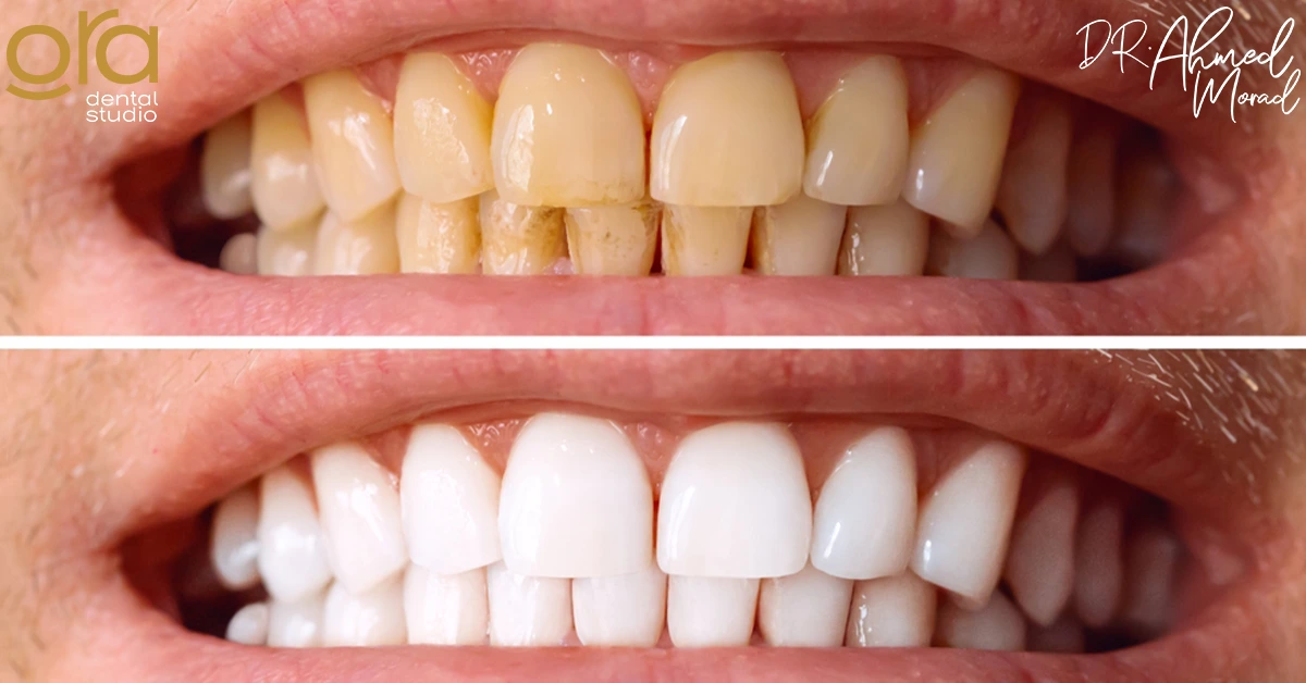 تبييض الأسنان بالليزر قبل وبعد