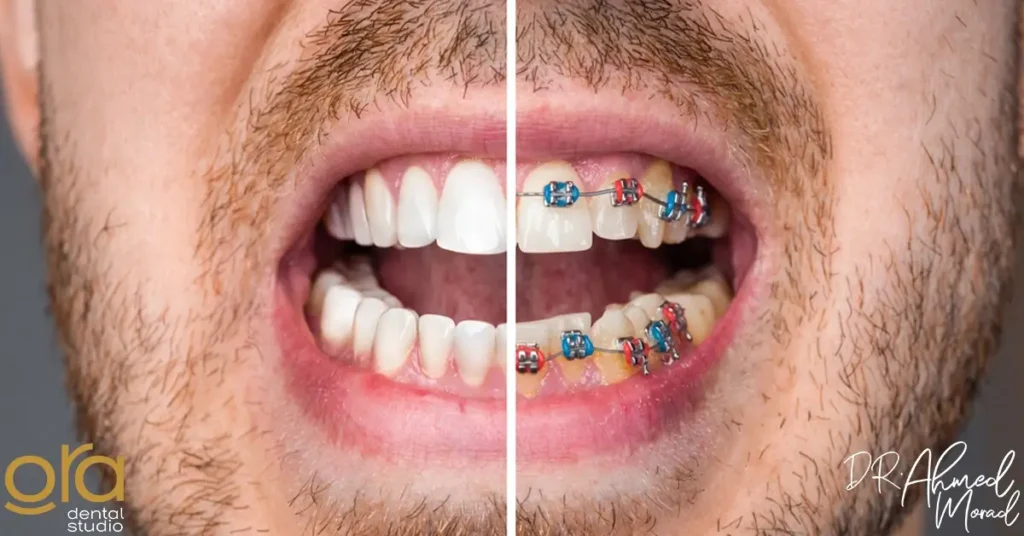 تبييض الأسنان بعد التقويم image