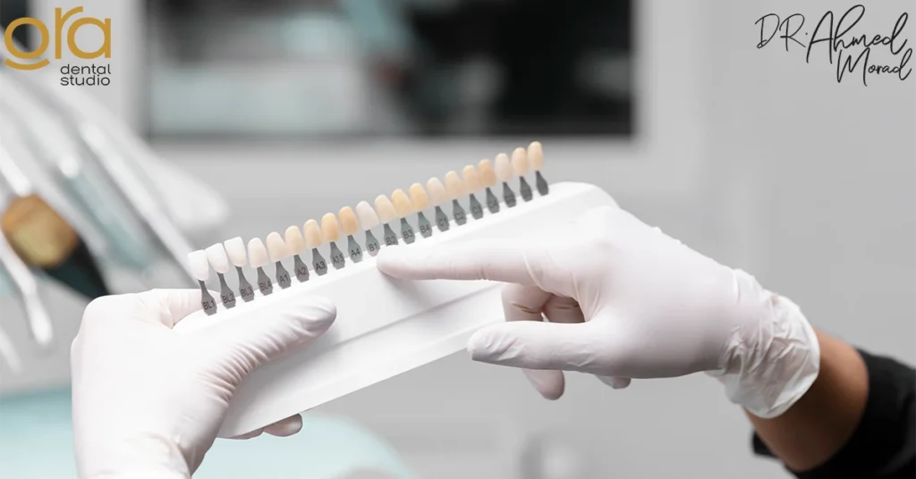 أسعار فينير الأسنان في مصر image