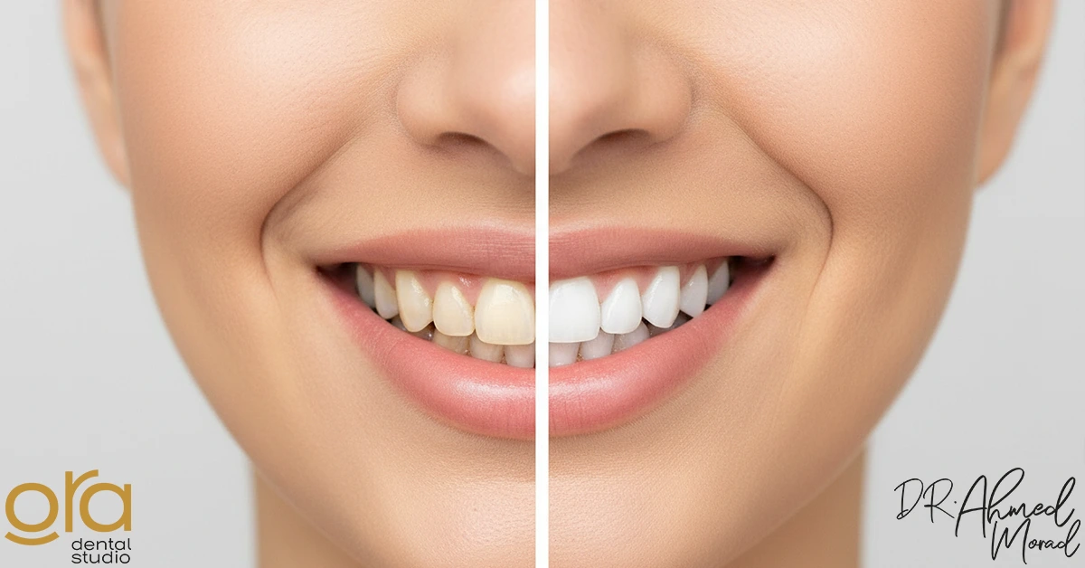 أسعار تبييض الأسنان في مصر