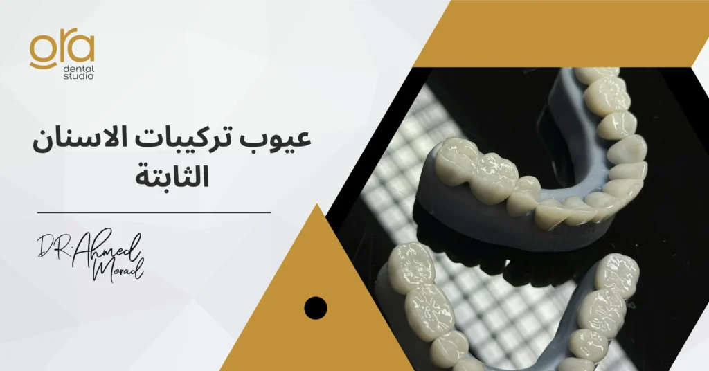 عيوب تركيبات الأسنان الثابتة image