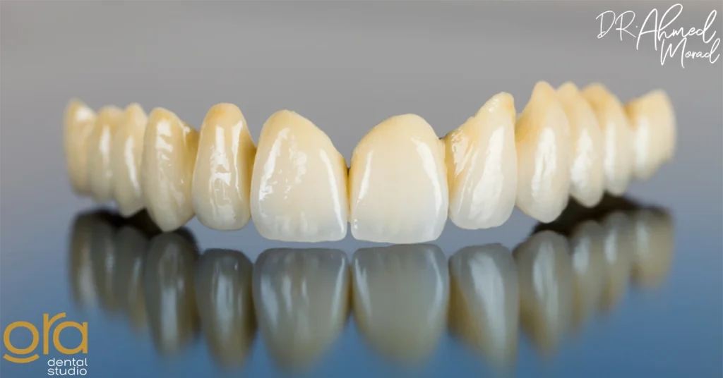 أنواع تركيبات الأسنان البورسلين image