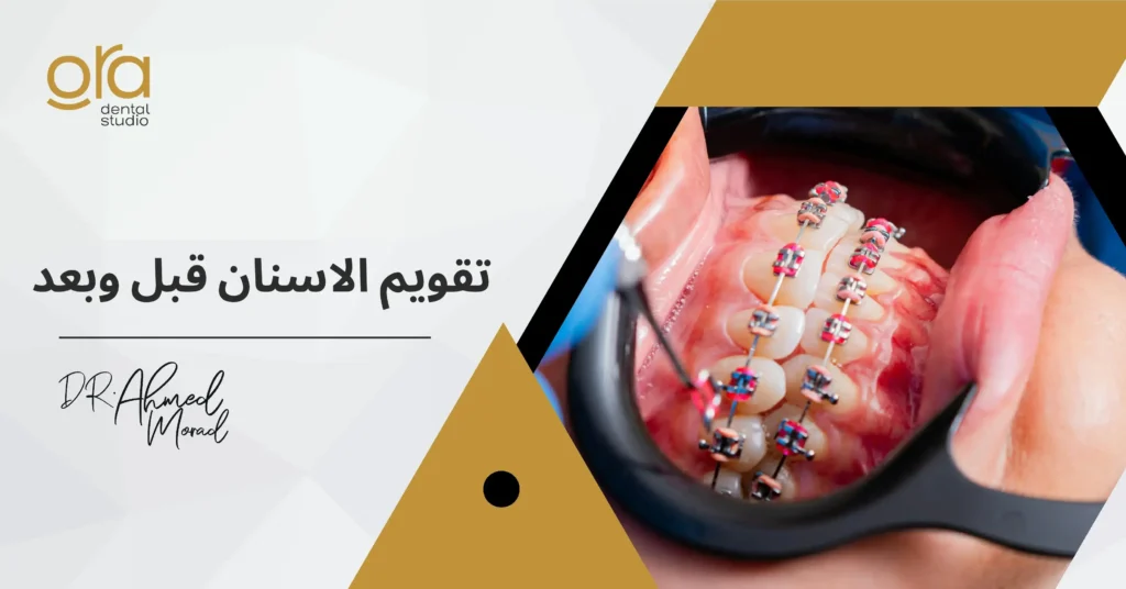 تقويم الأسنان قبل وبعد image