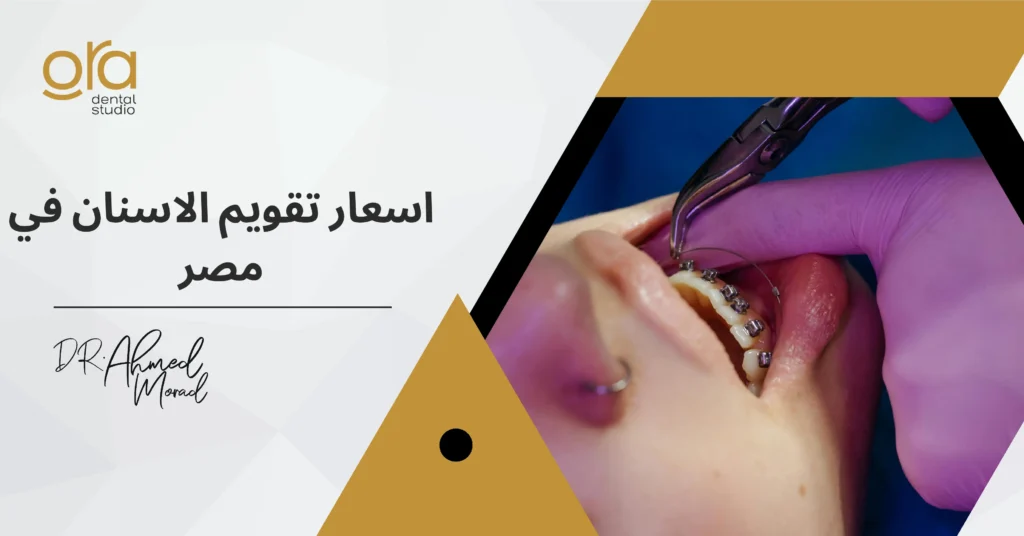 أسعار تقويم الأسنان في مصر image