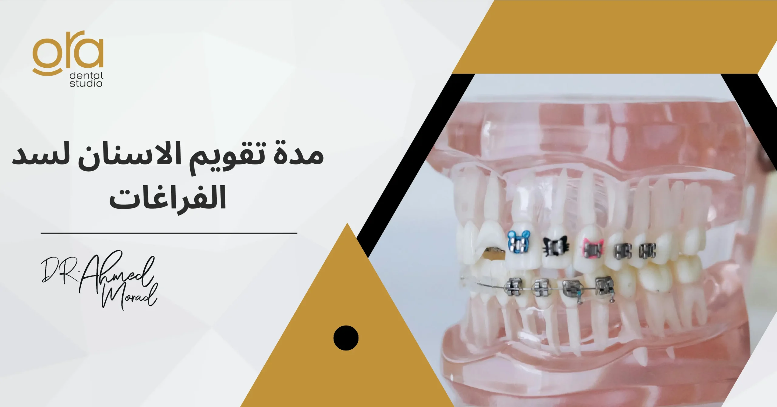 مدة تقويم الأسنان لسد الفراغات