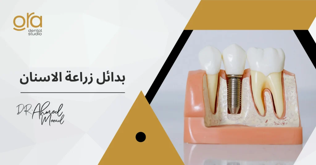 بدائل زراعة الأسنان​ image