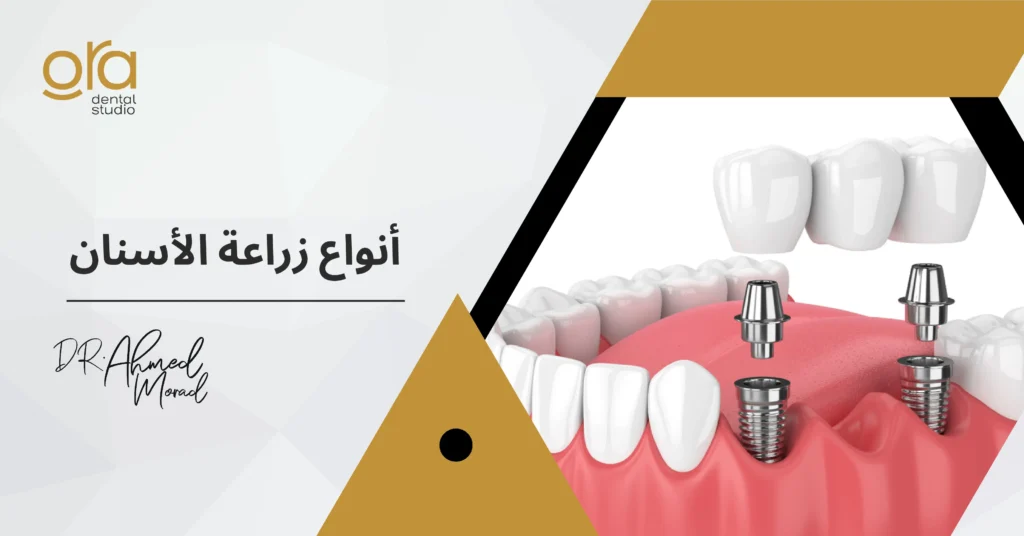 أنواع زراعة الأسنان image