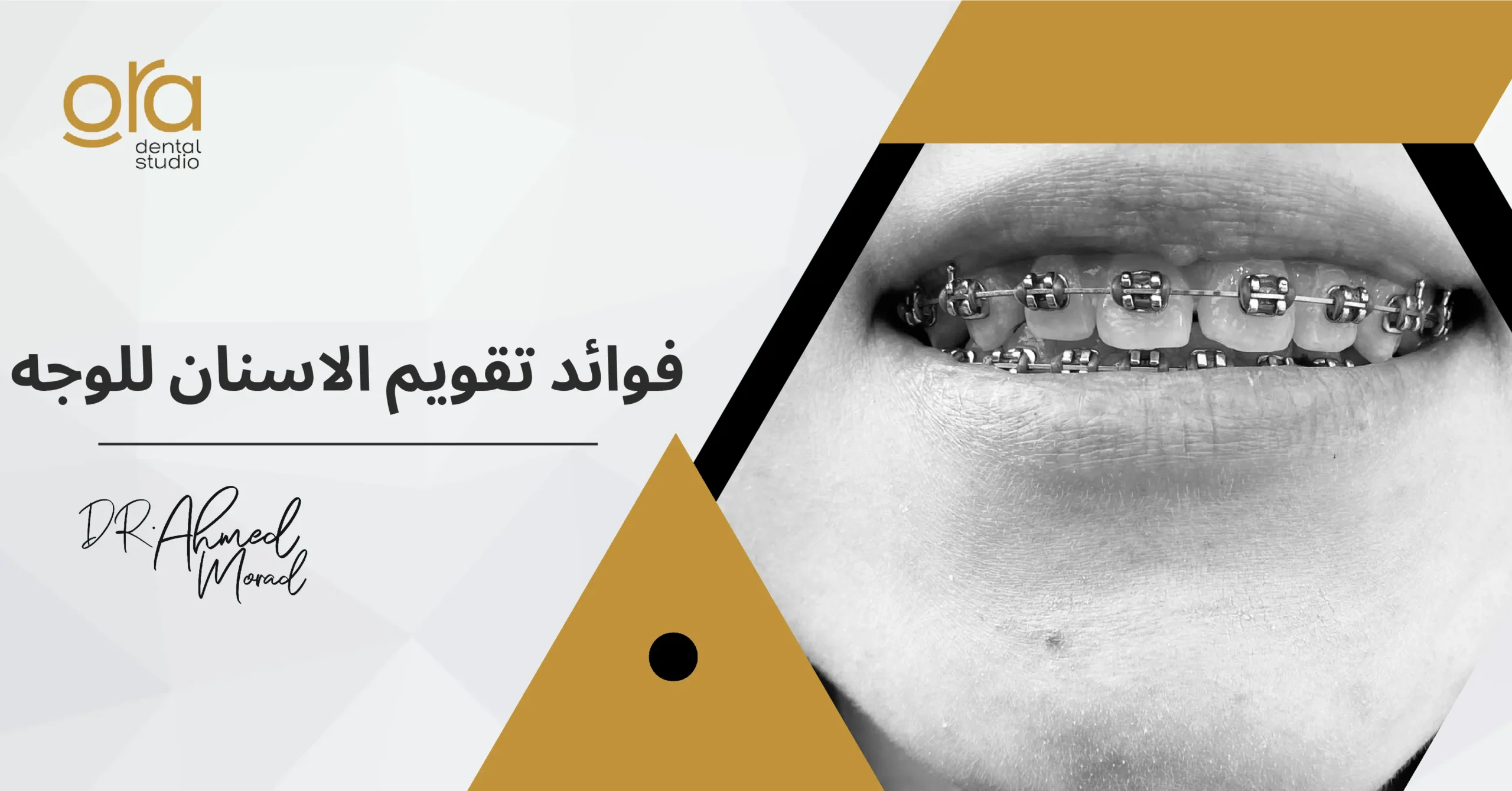 فوائد تقويم الأسنان للوجه