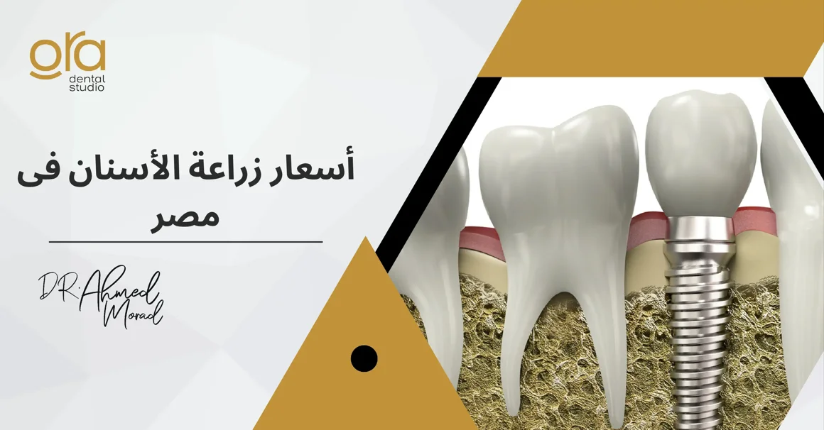 أسعار زراعة الأسنان في مصر