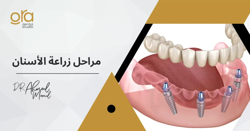 مراحل زراعة الأسنان image