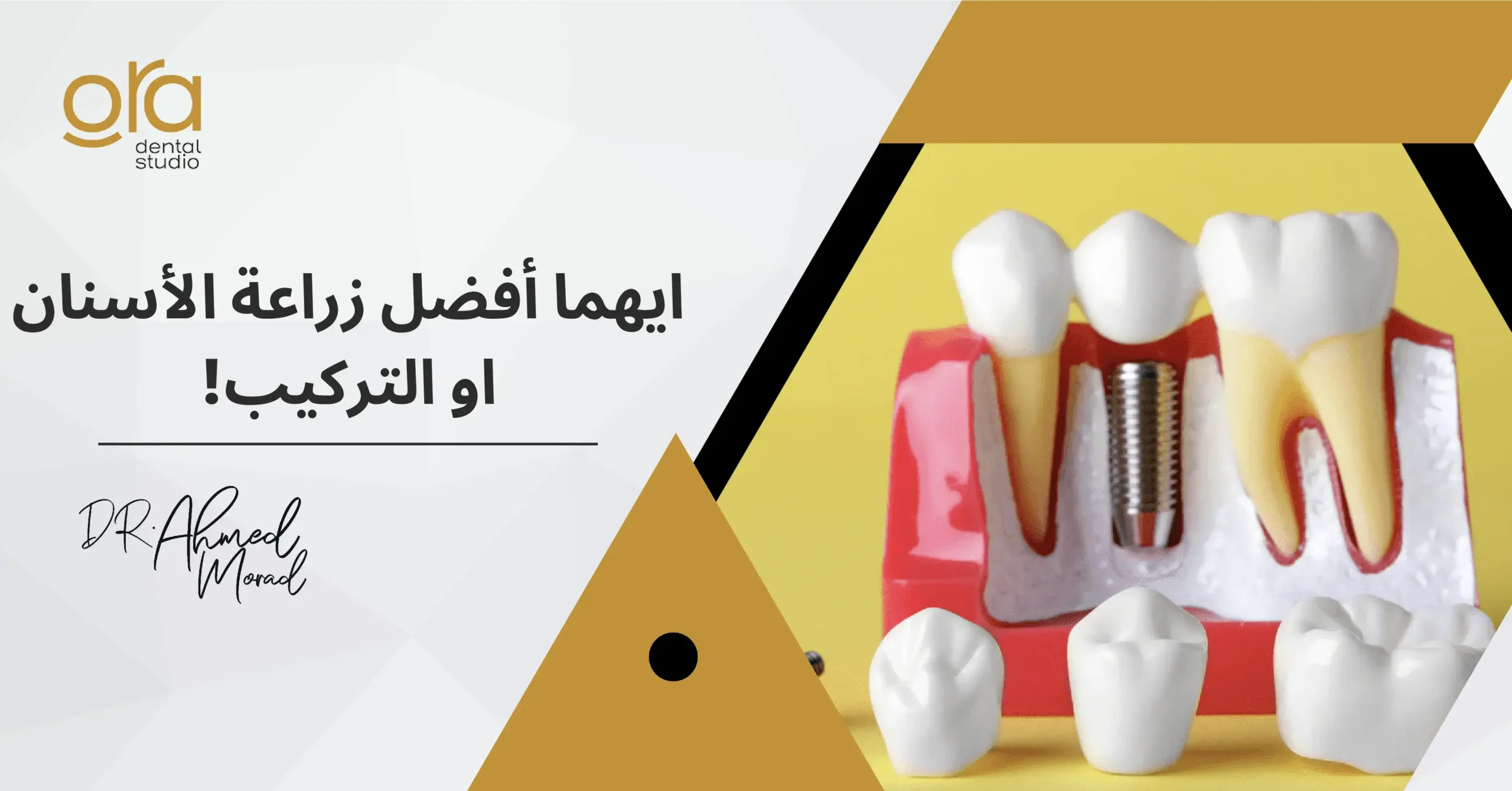 أيهما أفضل زراعة الأسنان أو التركيب