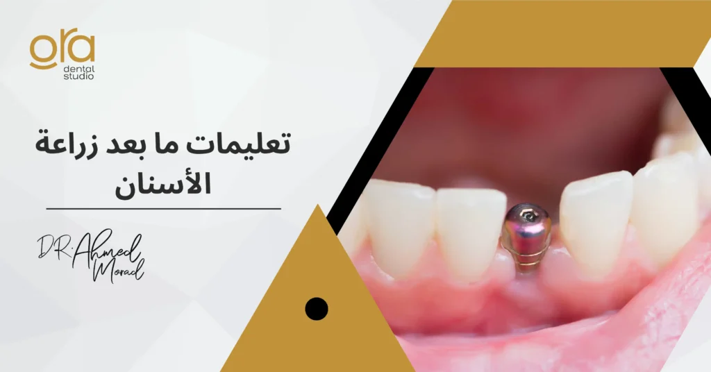 تعليمات ما بعد زراعة الأسنان image